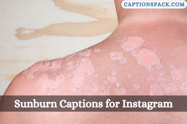 Sunburn Captions for Instagram